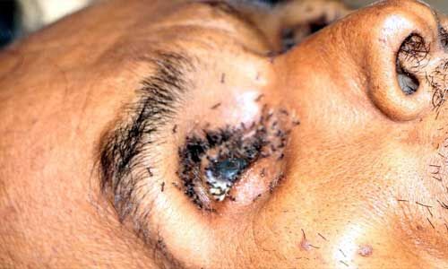 शिवपुरी : शव पर चीटियां लगने पर लापरवाही सामने आई, सिविल सर्जन सहित पांच पर गिरी गाज