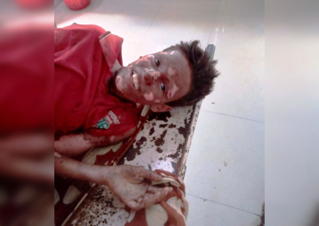 ओएचई की चपेट में आया बालक, 70 प्रतिशत झुलसा ओएचई की चपेट में आया बालक, 70 प्रतिशत झुलसा