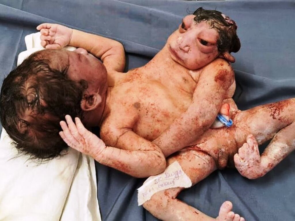 रतलाम में हुआ दो सिर एवं तीन हाथ वाले बच्चे का जन्म