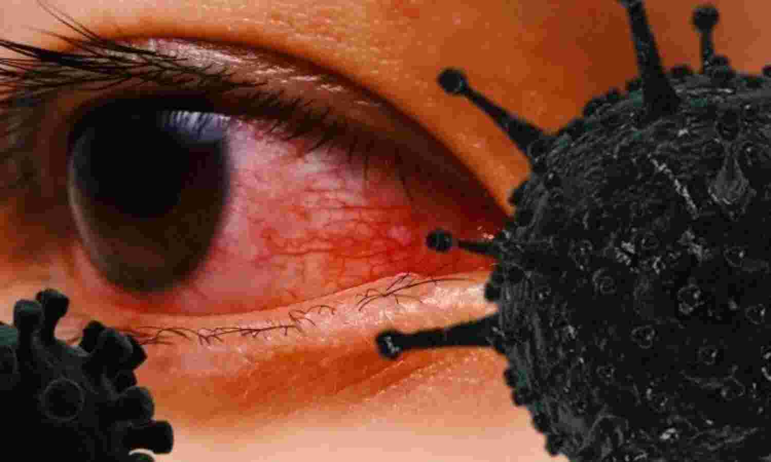 नियमित रूप से दें ब्लैक फंगस से ग्रसित मरीजों की जानकारी