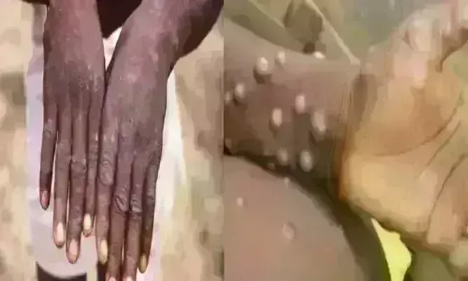 स्वास्थ्य विभाग ने मंकी पॉक्स को लेकर किया जारी किया अलर्ट, दस बेड का वार्ड बनाने के निर्देश