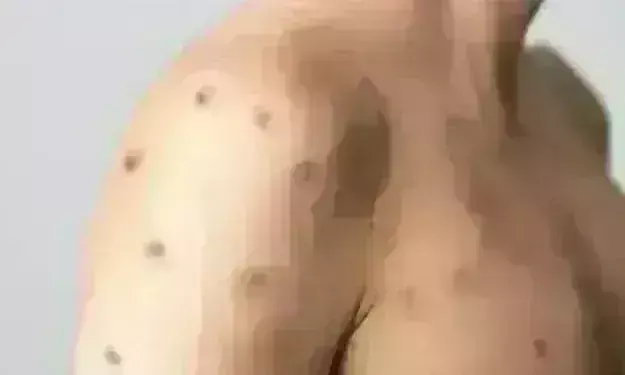 केरल में मिला मंकीपॉक्स का संदिग्ध मरीज, जानिए क्या लक्षण, किसे है ज्यादा खतरा