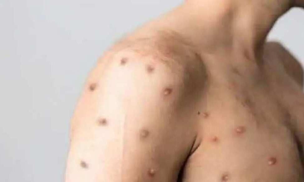 दिल्ली में मिला मंकिपॉक्स का नया मरीज, ट्रेवल हिस्ट्री ना होने से बढ़ी चिंता