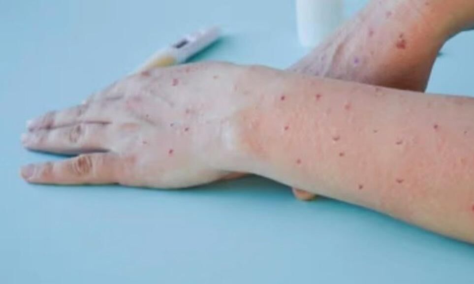 बिहार में मंकीपॉक्स के दो संदिग्ध मिले, जांच के लिए पुणे भेजे सैंपल