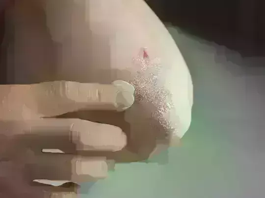 छूने से नहीं फैलती सोरायसिस, जानिए क्या है भ्रांतियां-लक्षण कैसे होता है इलाज ?