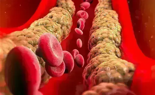 यदि आपके शरीर में दिखने लगे ये... चार लक्षण तो समझ जाइए बढ़ गया है बैड कोलेस्ट्रॉल