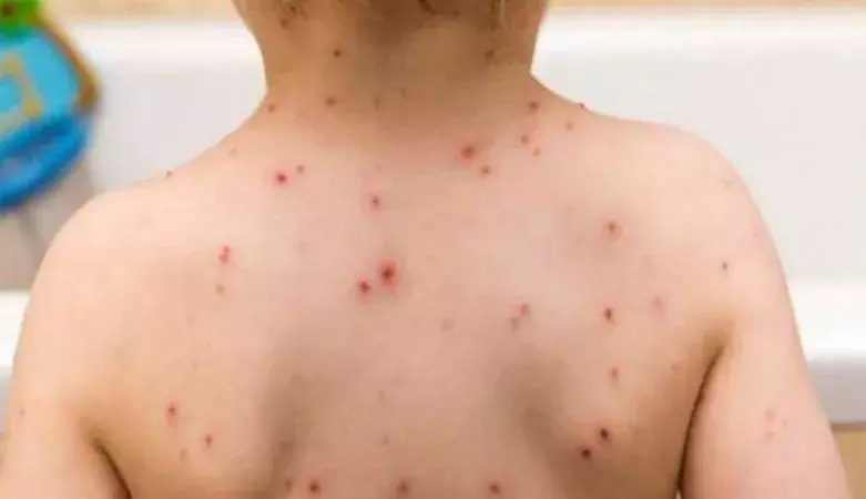 खसरे को देवी के प्रकोप से न जोड़े, बचने के लिए आवश्यक कराएं टीकाकरण