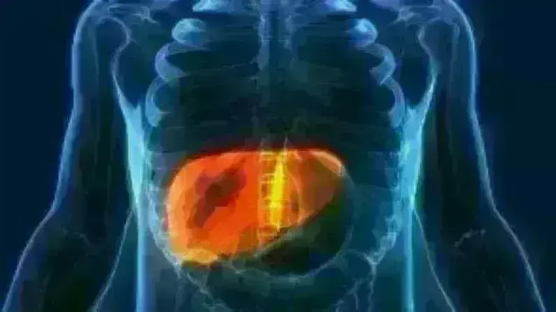 विश्व लीवर दिवस पर विशेष : लीवर को बीमार कर रही बदलती जीवन शैली