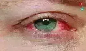 आई फ्लू: मौसम की  आंख मिचौली के  बीच आंखों में तेजी से फैल रहा संक्रमण,स्कूलों ने पेरेंट्स के लिए जारी की गाइडलाइन्स