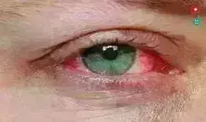 आई फ्लू: मौसम की  आंख मिचौली के  बीच आंखों में तेजी से फैल रहा संक्रमण,स्कूलों ने पेरेंट्स के लिए जारी की गाइडलाइन्स