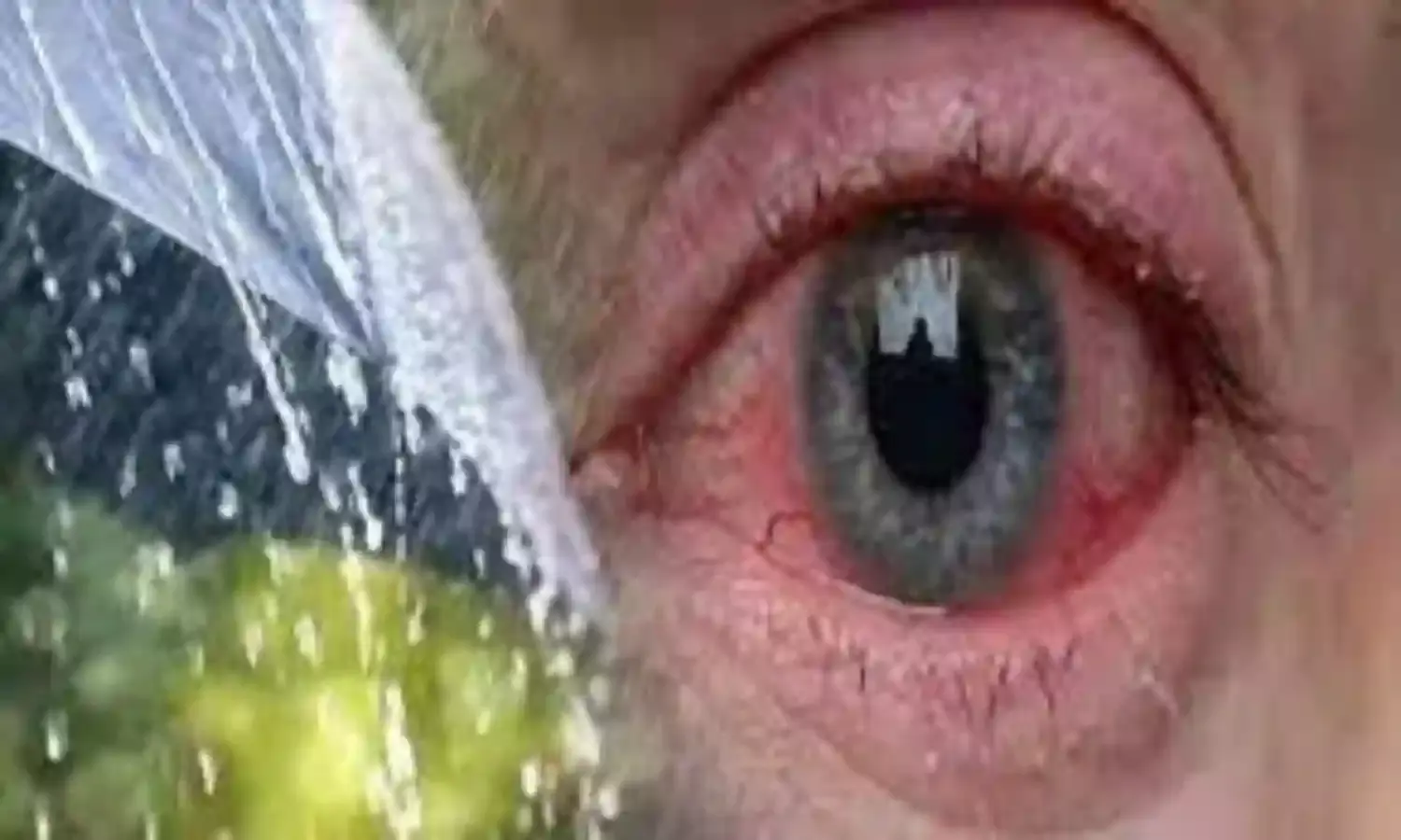 कंजक्टाइविस के मरीज बढ़े, स्वास्थ्य विभाग ने जारी किया अलर्ट