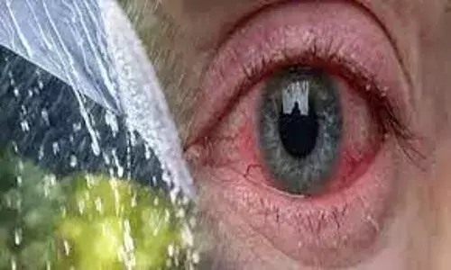 कंजक्टाइविस के मरीज बढ़े, स्वास्थ्य विभाग ने जारी किया अलर्ट
