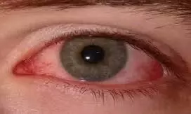 तेजी से बढ़ रही आंखों के लाल होने की बीमारी, मेडिकल स्टोर पर आईड्रॉप का स्टॉक हुआ कम