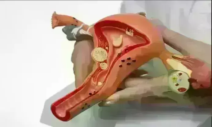 Cervical Cancer महिलाओं की मौत का बड़ा कारण, जानिए क्यों जरुरी है HPV वैक्सीन, कैसे लगवाएं ? Cervical Cancer महिलाओं की मौत का बड़ा कारण, जानिए क्यों जरुरी है HPV वैक्सीन, कैसे लगवाएं ?