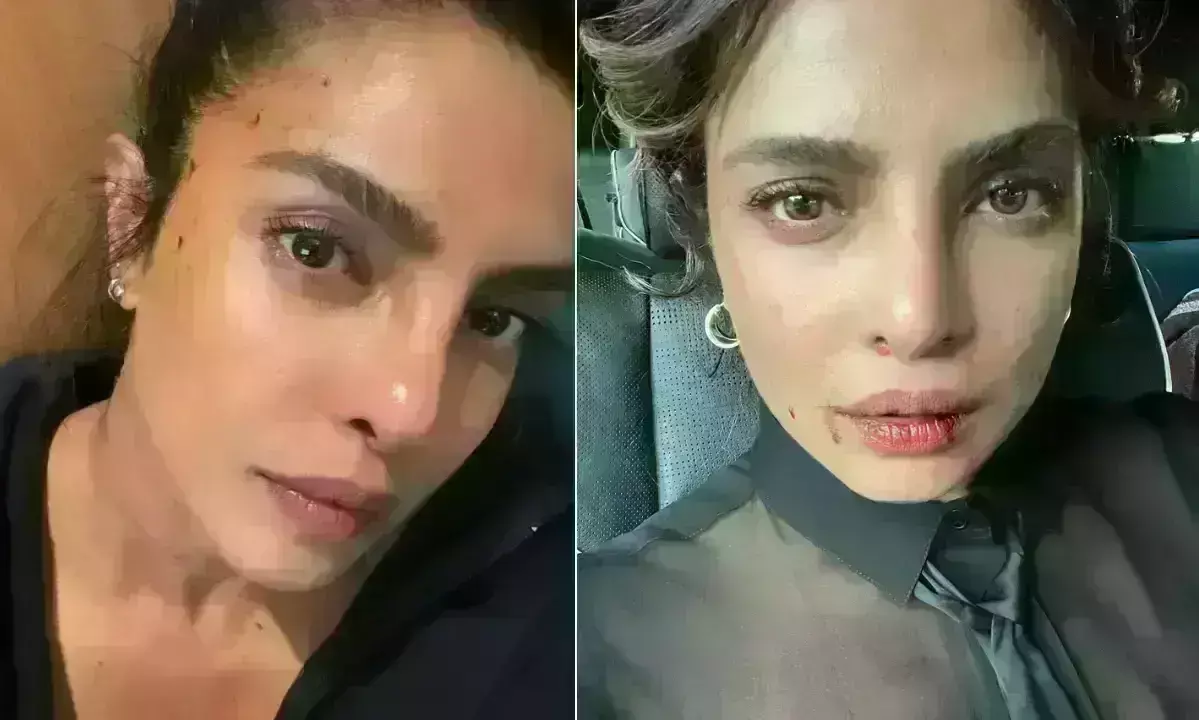 शूटिंग के दौरान घायल हुईं प्रियंका चोपड़ा, एक्ट्रेस ने शेयर की फोटो