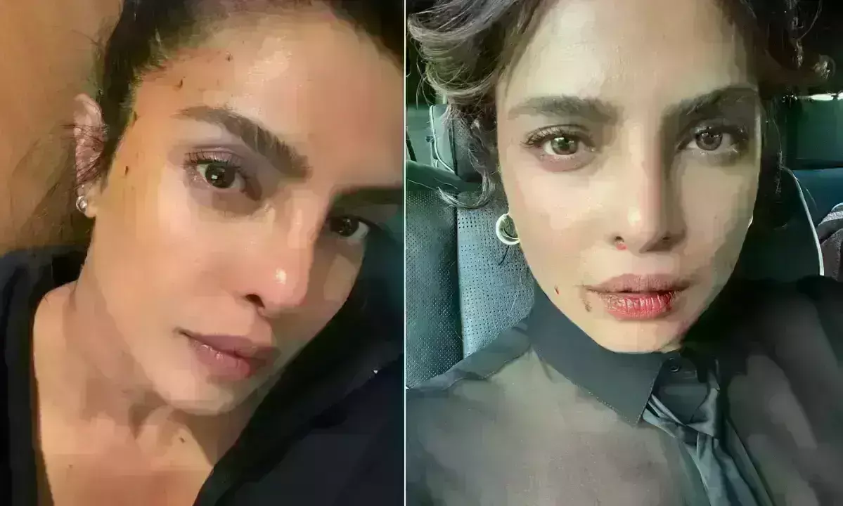 शूटिंग के दौरान घायल हुईं प्रियंका चोपड़ा, एक्ट्रेस ने शेयर की फोटो