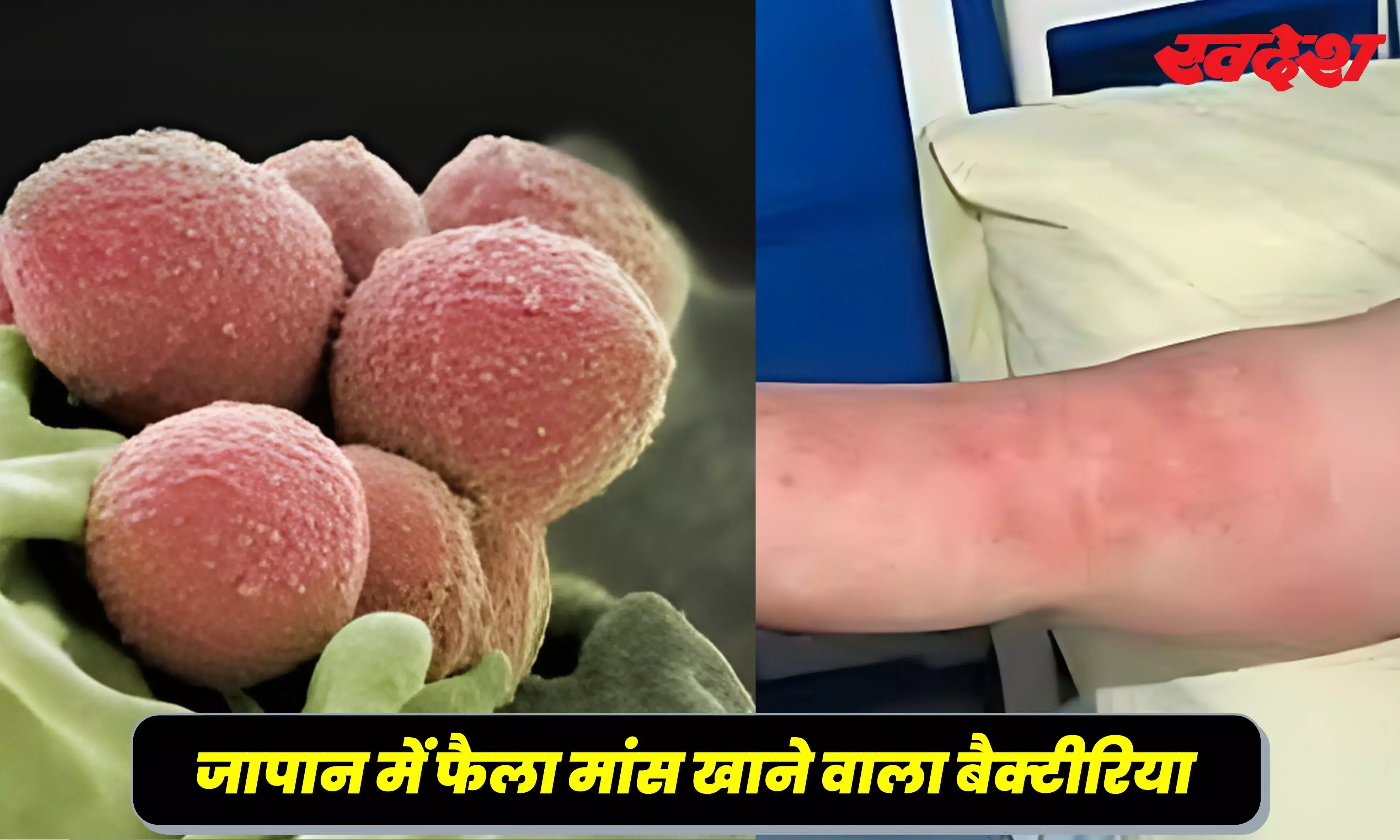 जापान में फैली खतरनाक बीमारी, मरीज का मांस खाने लगता है बैक्टीरिया, दो दिनों में मौत का खतरा जापान में फैली खतरनाक बीमारी, मरीज का मांस खाने लगता है बैक्टीरिया, दो दिनों में मौत का खतरा