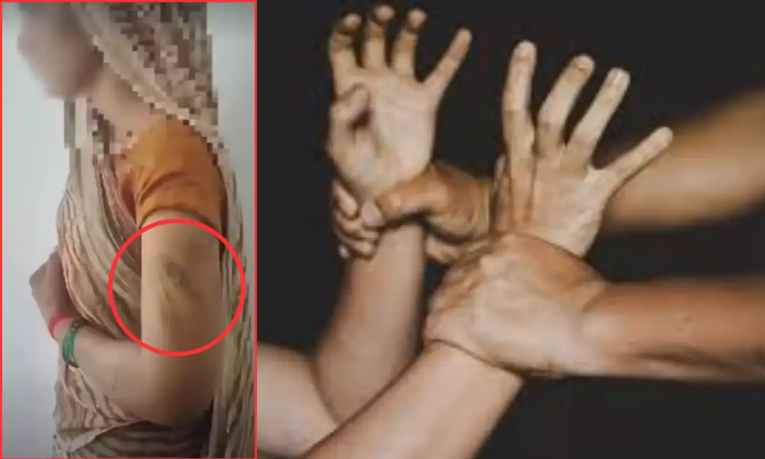 पति को चुकाना था कर्ज, पत्नी मायके नहीं लाई 5 लाख नगद तो पति ने चिमटे से दागा