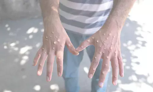 मंकीपॉक्स के इमरजेंसी घोषित होने के बाद अलर्ट मोड पर भारत, 17 अगस्त को होगी बैठक