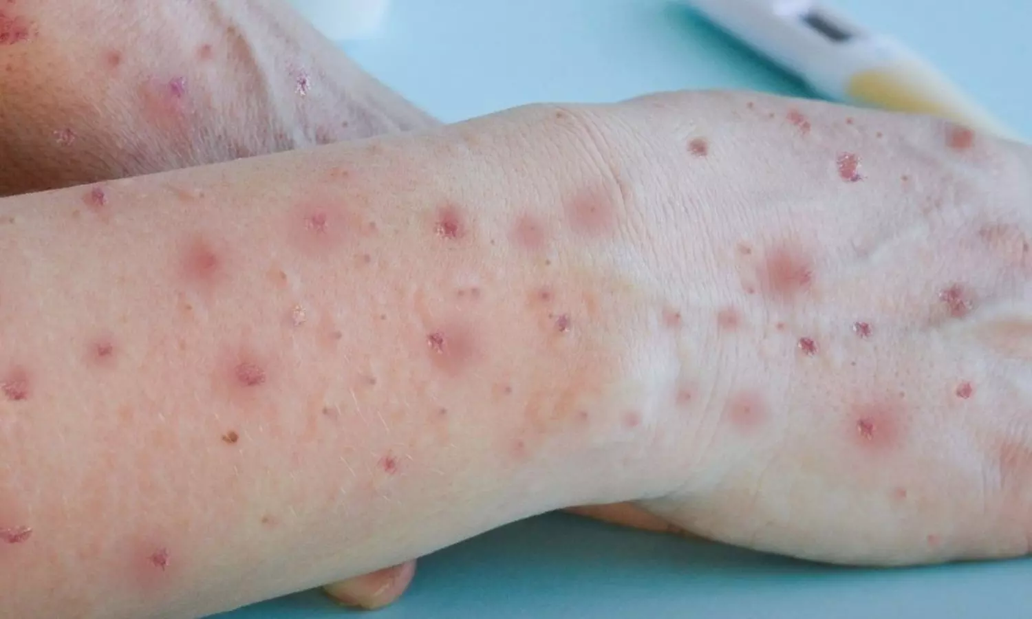 भारत में एमपॉक्स के पहले मरीज की पुष्टि, केंद्र सरकार ने जारी की राज्यों के लिए एडवाइजरी भारत में एमपॉक्स के पहले मरीज की पुष्टि, केंद्र सरकार ने जारी की राज्यों के लिए एडवाइजरी