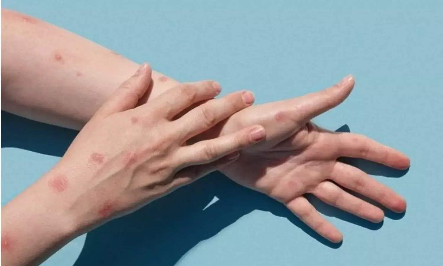 दिल्ली के बाद केरल में मिला मंकीपॉक्स का दूसरा केस, स्वास्थ्य विभाग हुआ अलर्ट