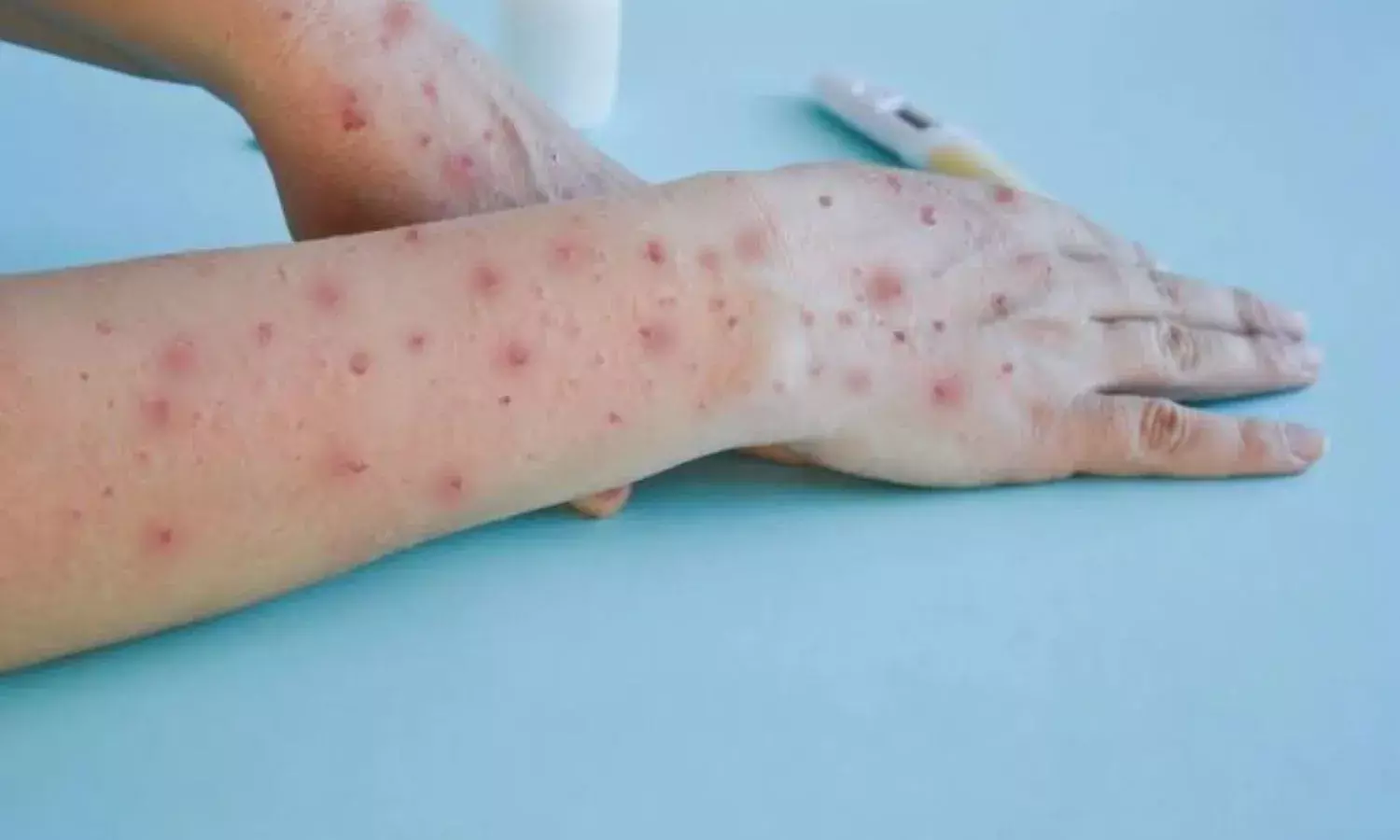 हो जाएं सावधान! भारत में मंकीपॉक्स वायरस के इस स्ट्रेन का मिला पहले मरीज, अलर्ट जारी