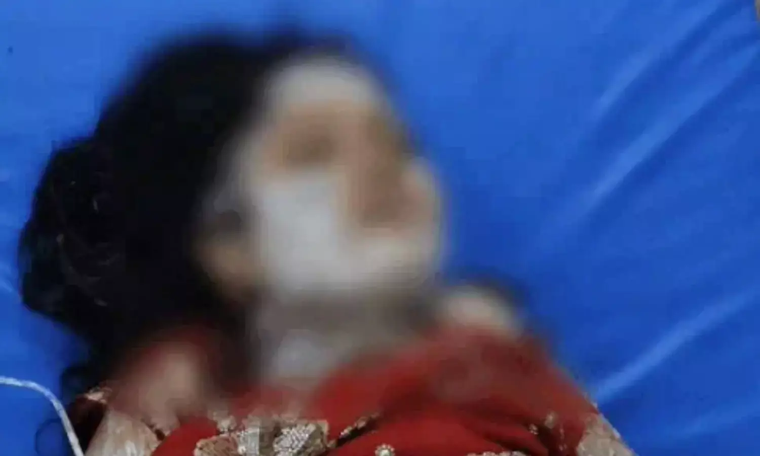 बांदा में भाई ने की बहन से रेप की कोशिश, विरोध करने पर जिंदा जलाया, महिला की हालत गंभीर