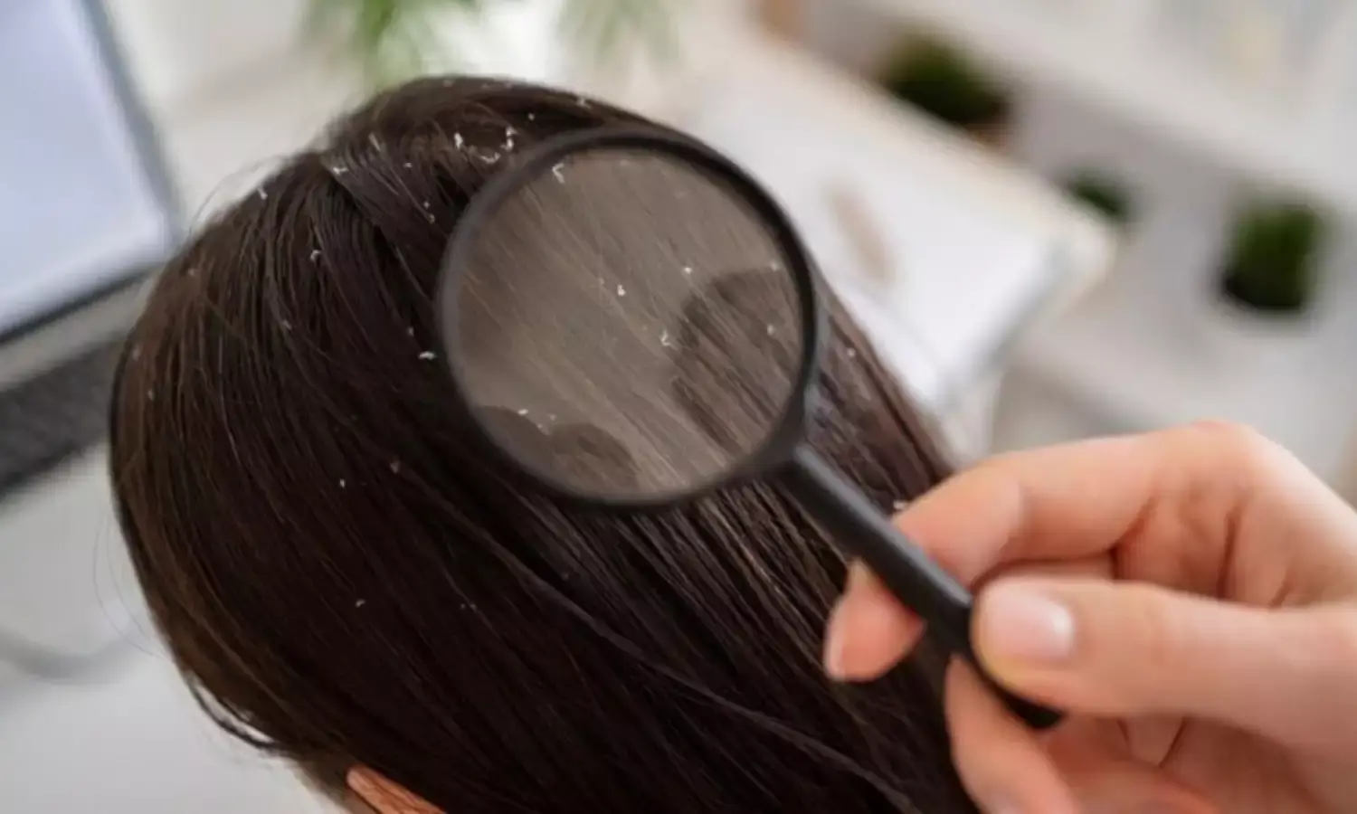 सर्दियों में डैंड्रफ से बाल हो रहे खराब, जानिये बचाव के लिए एक्सपर्ट की राय सर्दियों में डैंड्रफ से बाल हो रहे खराब, जानिये बचाव के लिए एक्सपर्ट की राय