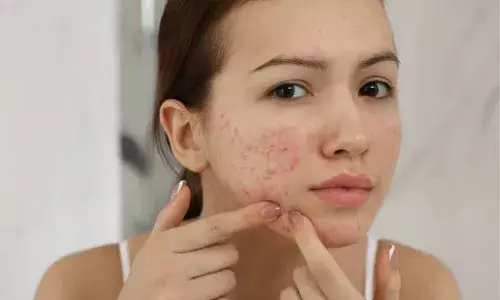 आपके चेहरे पर भी निकलते हैं मुंहासे, जानें क्या है इसकी वजह और कैसे करें उपाय