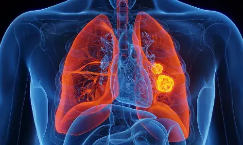 सिगरेट न पीने वालों में भी बढ़ रहे लंग कैंसर के मामले, चौंकाने वाली है यह रिपोर्ट