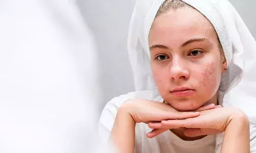 पिंपल्स से छुटकारा पाने के लिए क्या करें? जानें आसान टिप्स