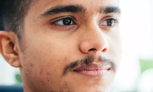 होली के रंग से चेहरे पर निकल रहे दाने, जानें क्या करें उपाय