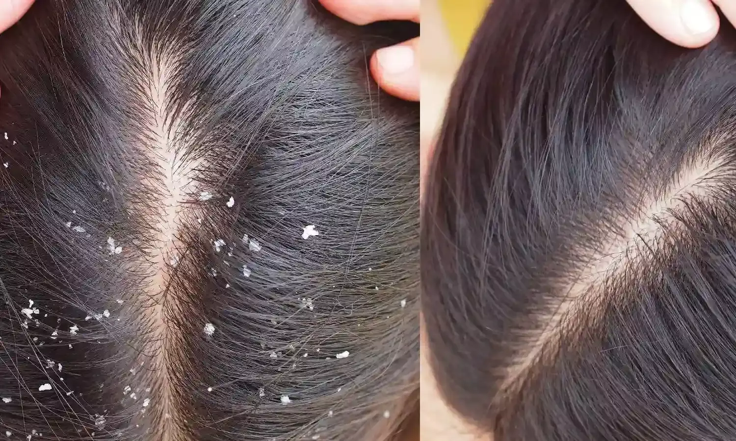 डैंड्रफ से छुटकारा पाने के लिए अपनाएं ये घरेलू उपाय