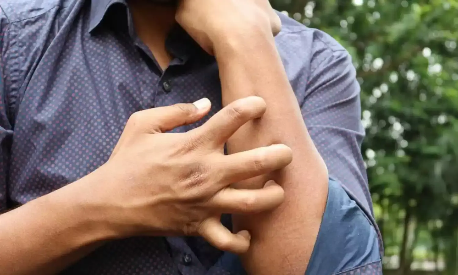 गर्मी-बरसात में रैशेज और घमौरियों से राहत दिलाएंगे ये आसान घरेलू नुस्खे