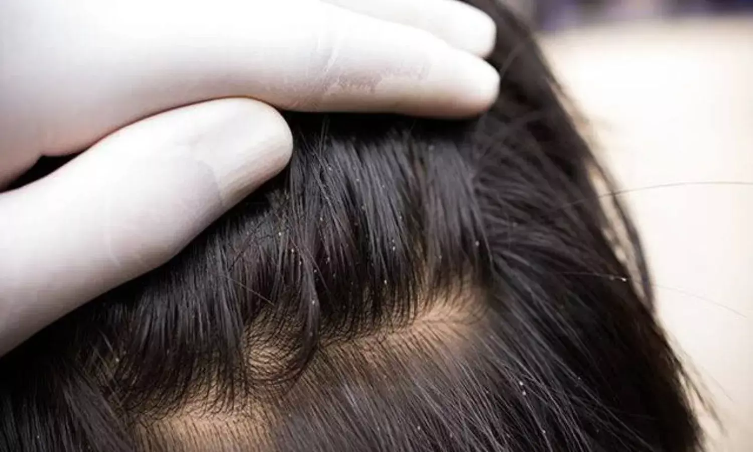 बारिश के मौसम में क्या आप भी बालों में जुएं की समस्या से हो गए हैं परेशान, इन घरेलू नुस्खों का करें इस्तेमाल