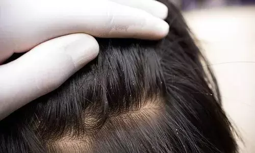 बारिश के मौसम में क्या आप भी बालों में जुएं की समस्या से हो गए हैं परेशान, इन घरेलू नुस्खों का करें इस्तेमाल