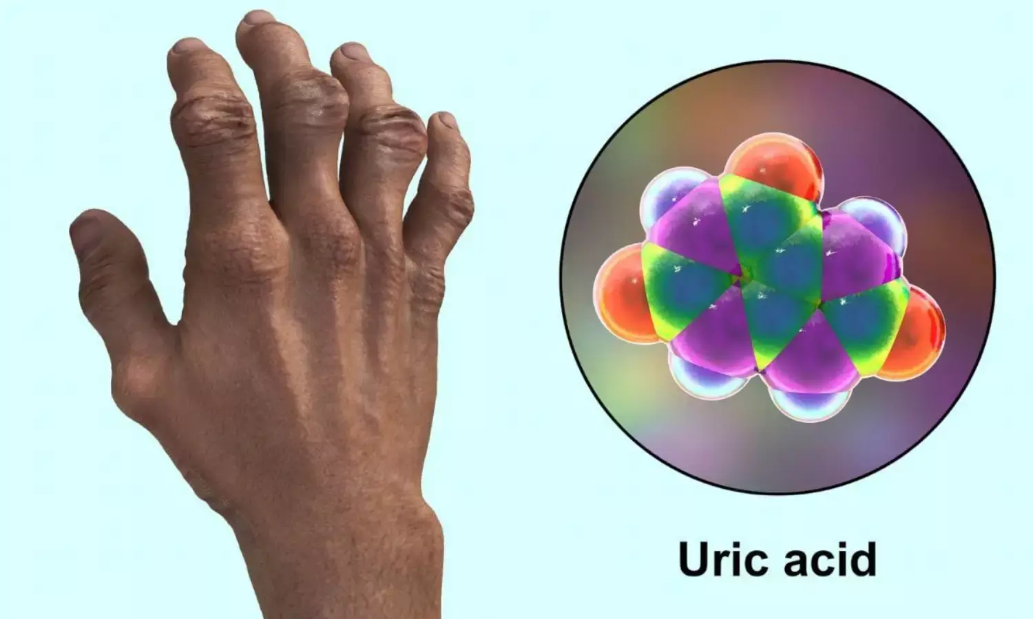 यूरिक एसिड बढ़ना है बेहद खतरनाक, शरीर के इन अंगों को हो सकता है नुकसान
