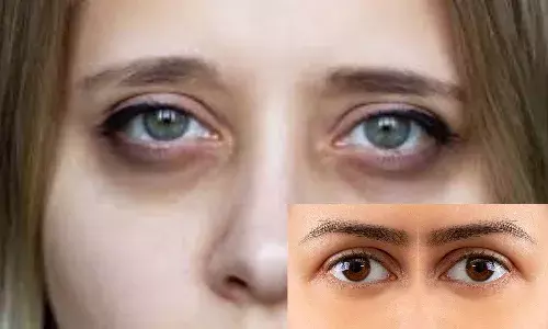 15 दिनों में आंखों के काले घेरे हो जाएंगे छूमंतर! इन नुस्खों के साथ यदि खाया ये पाउडर तो अंदर से भी आएगा निखार