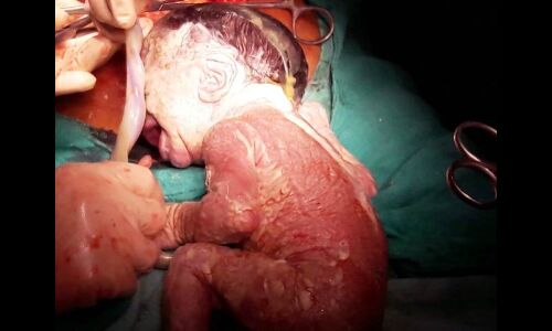 बच्चेदानी के बाहर पेट में पल रहा था बच्चा, लाखों में आता है एक मामला बच्चेदानी के बाहर पेट में पल रहा था बच्चा, लाखों में आता है एक मामला