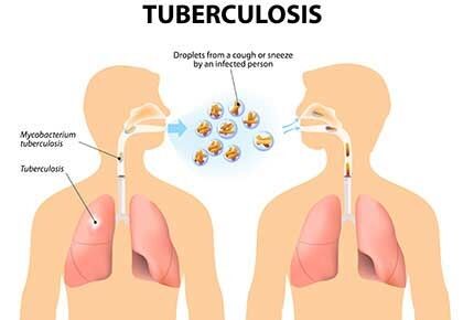 देश में बनी दवा से खत्म होगी टीबी की बीमारी