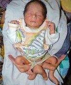 कराची में 6 पांव वाले बच्चे का सफल ऑपरेशन