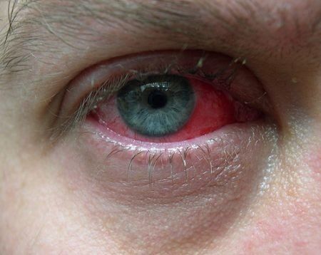 आंख लाल होने पर तत्काल डॉक्टरों से ले सलाह